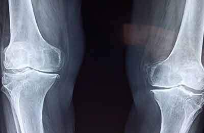 تشخیص علائم اولیه پوکی استخوان با هوش مصنوعی